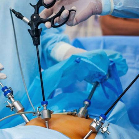 Advanced laparoscopic Urology in Ghatkesar