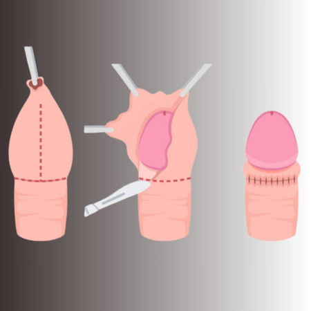 Phimosis Treatment in ghatkesar